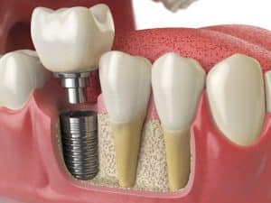 Dental Implant Crown